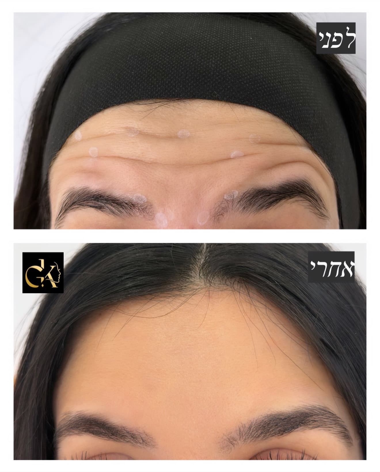 תוצאת טיפול בקמטי הבעה במצח לפני ואחרי שאושרה לפרסום